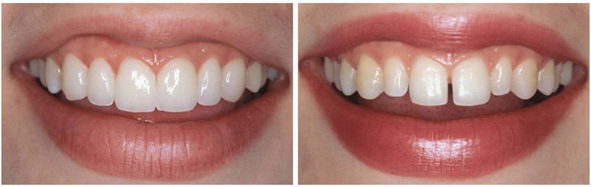 Что Такое Реставрация Зубов В Стоматологии Фото